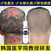 韩国头皮毛囊去螨虫炎洗发水去屑止痒控油除螨露头皮清洁非脱神器